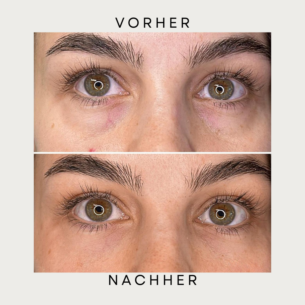 Ems EyePads - LED Augenmassagegerät mit Gel-Pflastern